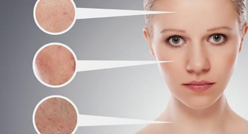 5 cach tri mun cam o mat mui ma cam tran ?? hieu qua nhat tai nha