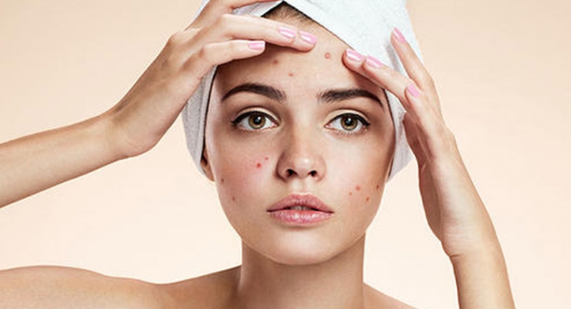 nhung dieu ban can nho khi cham soc da mun