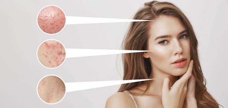 nhung thuc pham ho tro giam mun noi tiet an toan hieu qua