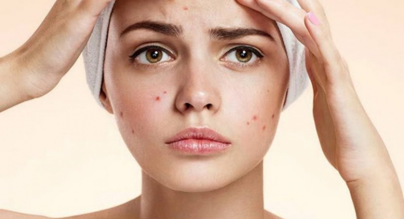 phan biet cac loai mun tren mat thuong gap