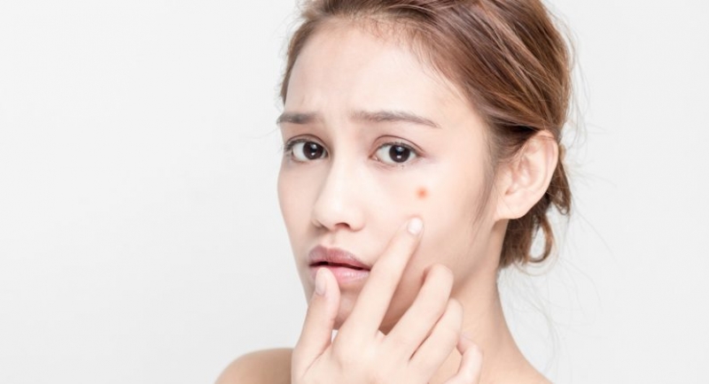 top 4 cach tri mun tham tai nha hieu qua va an toan